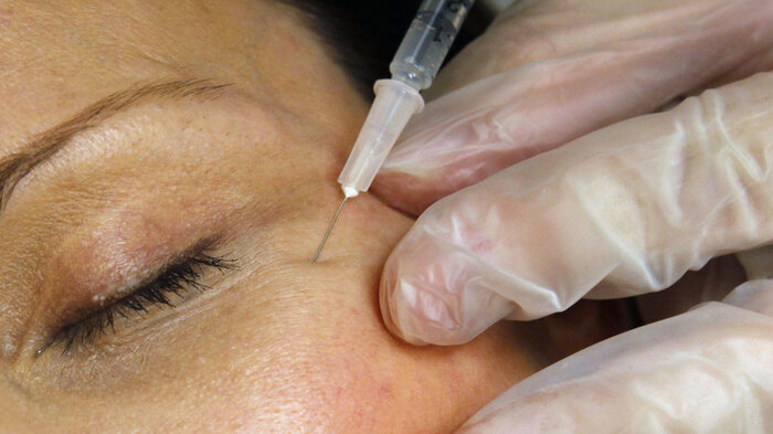 Bildet viser botox-injeksjon