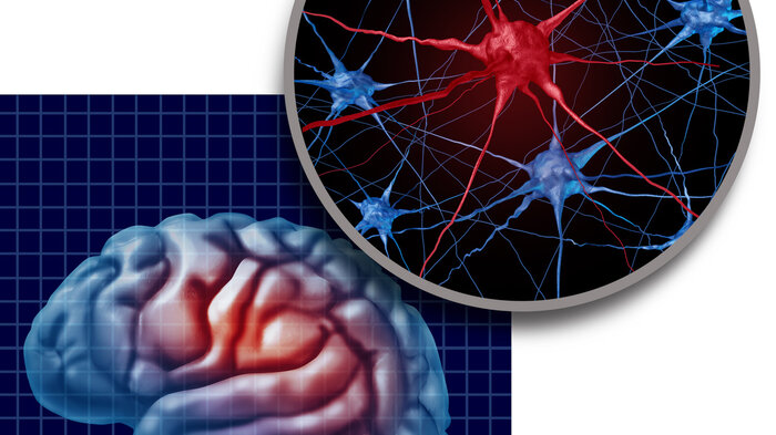 Bildet viser en illustrasjon av en hjerne med Parkinson sykdom Bildet viser en illustrasjon av en hjerne med Parkinson sykdom