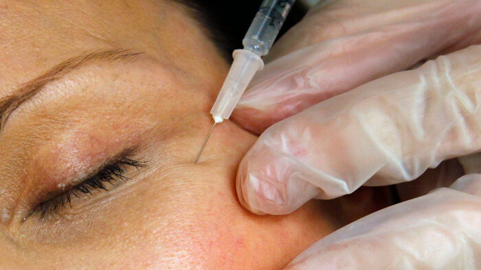 Bildet viser en kvinne som får injisert botox.