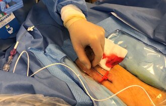 Bildet viser en anestesisykepleier som legger inn PICC-line