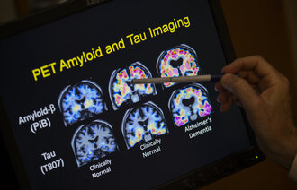 Bildet viser normal hjerne, og hvordan det gradvis dannes senile plakk av proteinet beta-amyloid og nevrofibrillære floker av proteinet tau