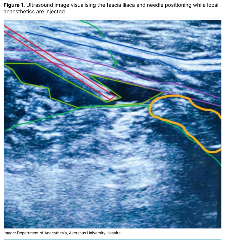 Figure 1. Ultrasound image visualising the fascia iliaca and needle positioning while local anaesthetics are injected Figure 1. Ultrasound image visualising the fascia iliaca and needle positioning while local anaesthetics are injected