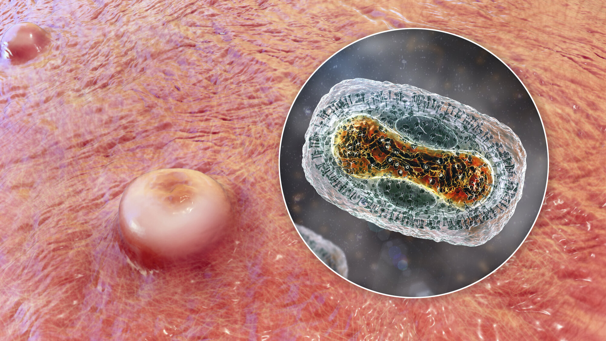 Apekopper Bildet viser apekoppe-lesjon og innfelt virus.