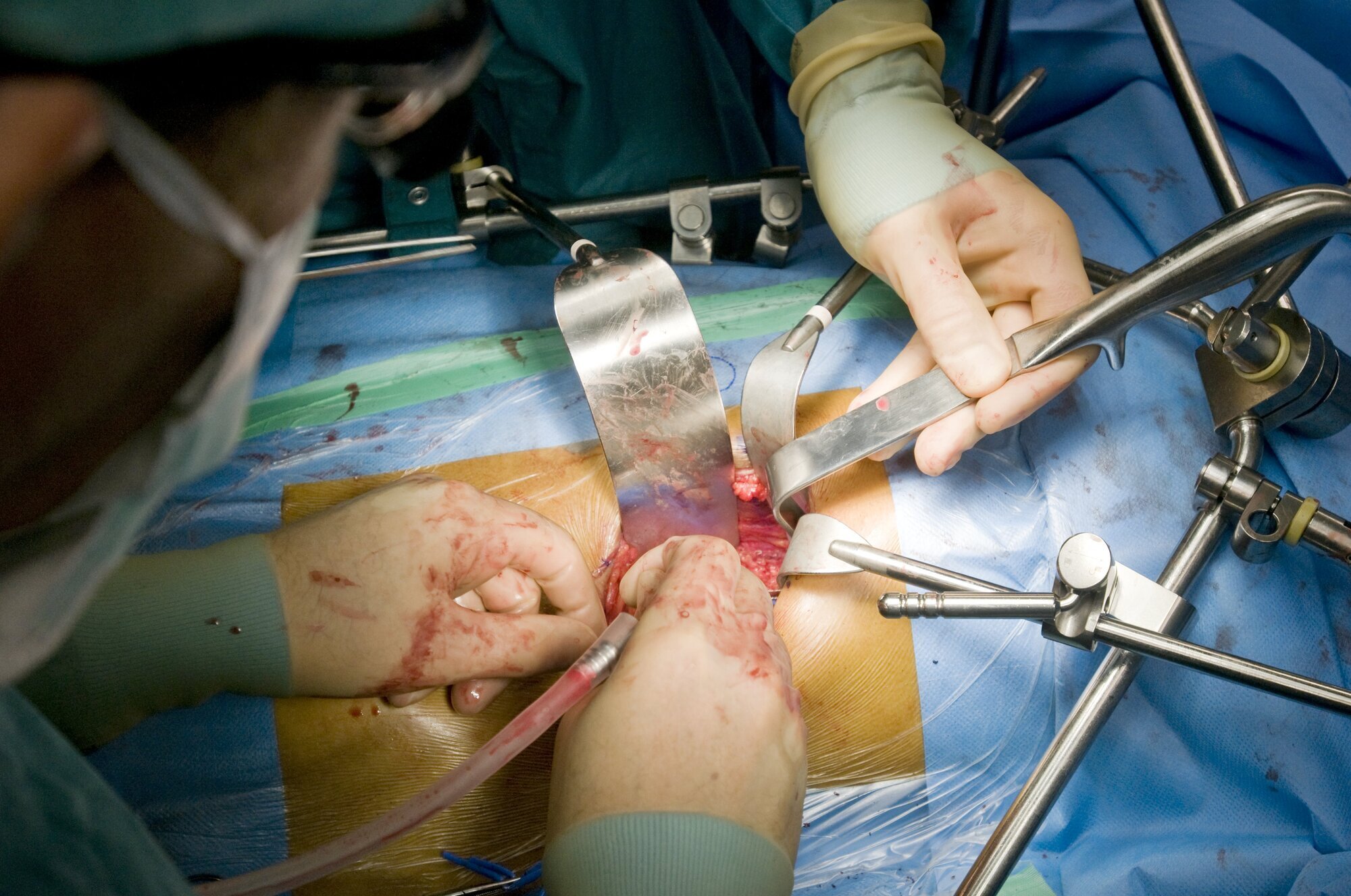Bildet viser en nyretransplantasjon Bildet viser en nyretransplantasjon