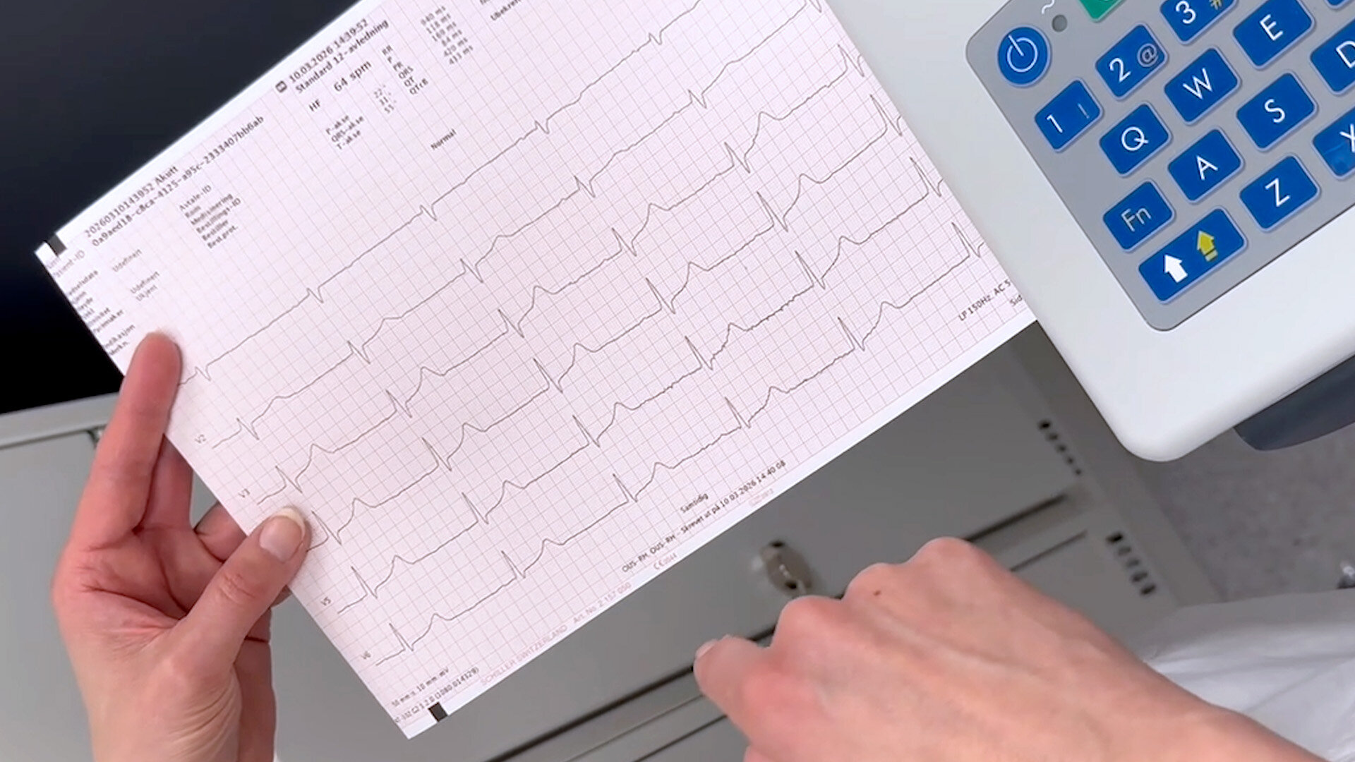 Bilde viser EKG utskrift