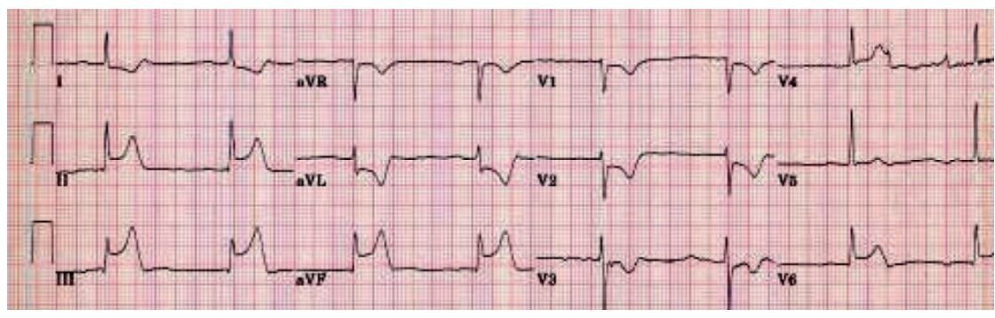 Bilde av EKG Bilde av EKG