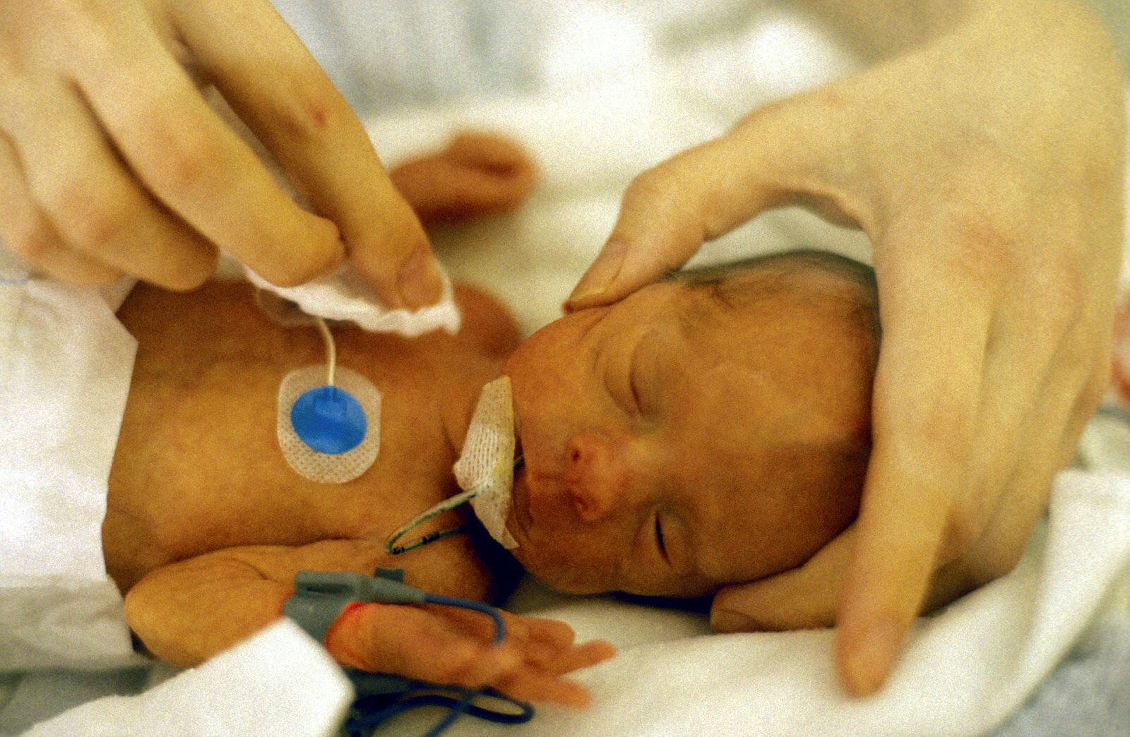 Prematur Prematurt barn som stelles i kuvøse