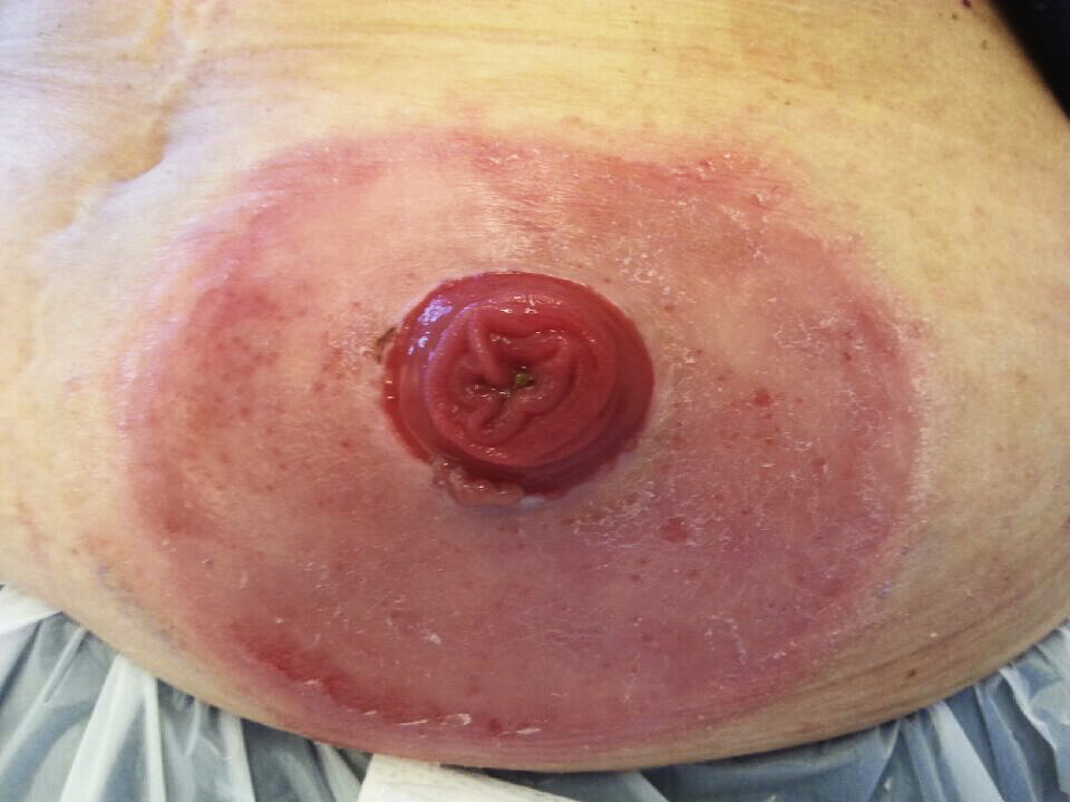 Psoriasis stomi