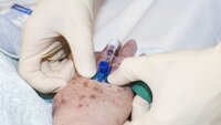 Innleggelse av perifert venekateter Bildet viser hendene til en sykepleier, som holder på å legge inn perifert venekateter på en hånd til en eldre person