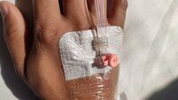 Perifert venekateter Bildet viser et PVK (perifert venekateter) i hånden