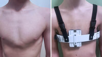 Bildet viser korsettbehandling ved pectus carinatum