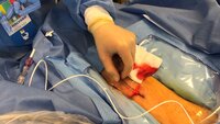 Bildet viser en anestesisykepleier som legger inn PICC-line