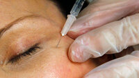 Bildet viser en kvinne som får injisert botox.