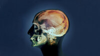 Person med hydrocephalus med innoperert shunt. Bildet viser et røntgenbilde av et hode sett fra siden, der man kan se shunten inne i hodet.